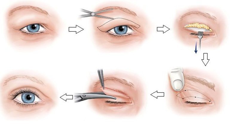 Quy trình cơ bản của cắt mí mắt