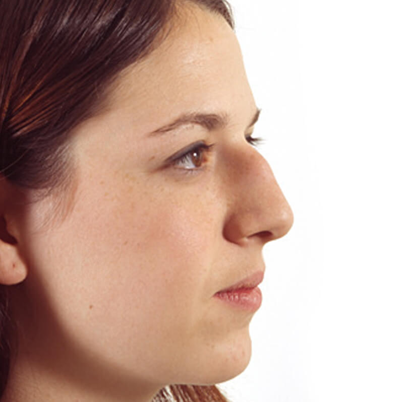 Chuyên gia bật mí cách xử lý mũi ngắn, gãy, thấp, tẹt, mũi hếch hiệu quả