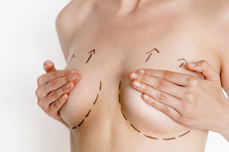Top 5 phương pháp nâng ngực an toàn nhất mà chị em nên biết